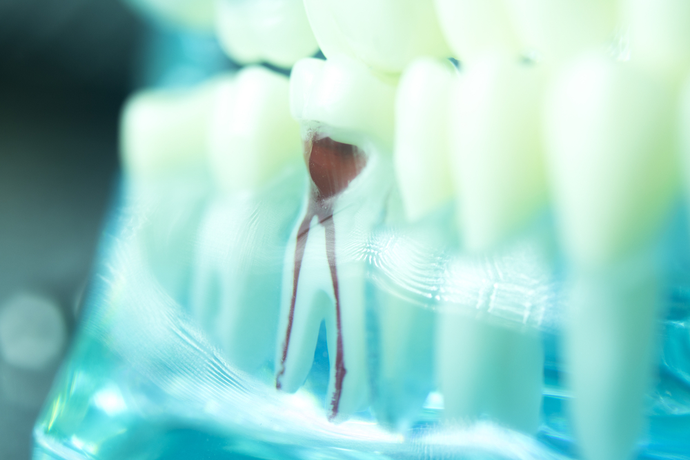 Endodontic Therapy Creve Coeur, MO | Creve Coeur, MO Endodontist | Martin Dental & Associates