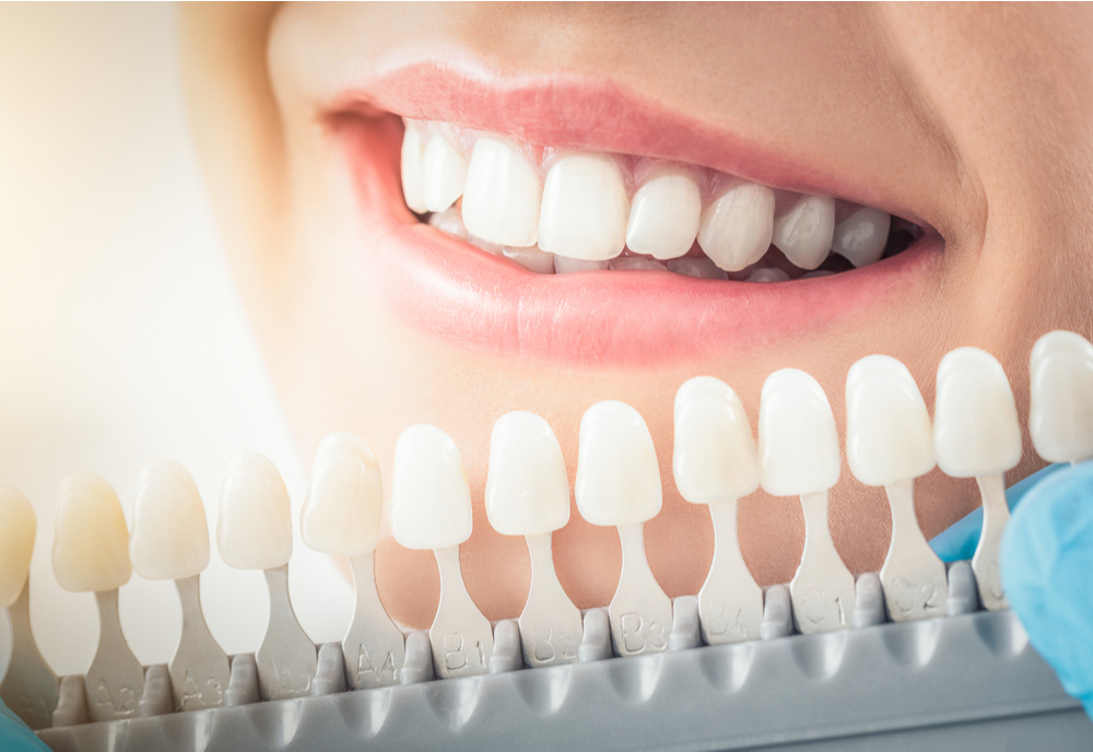 tooth-fillings-Bellerive-MO |  Bellerive, MO tooth-colored fillings | Martin Dental & Associates