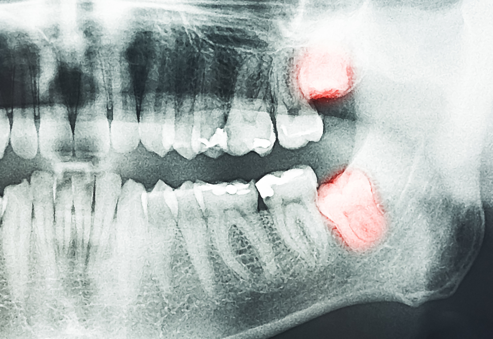 wisdom tooth removal in Huntleigh, MO | Huntleigh, MO wisdom teeth removal surgery