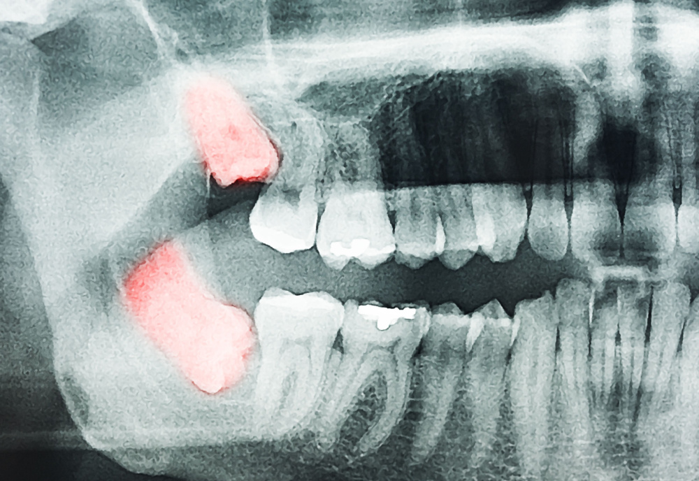 Wisdom Teeth Surgery Town and Country, MO | Town and Country, MO Wisdom Teeth Removal | Martin Dental & Associates