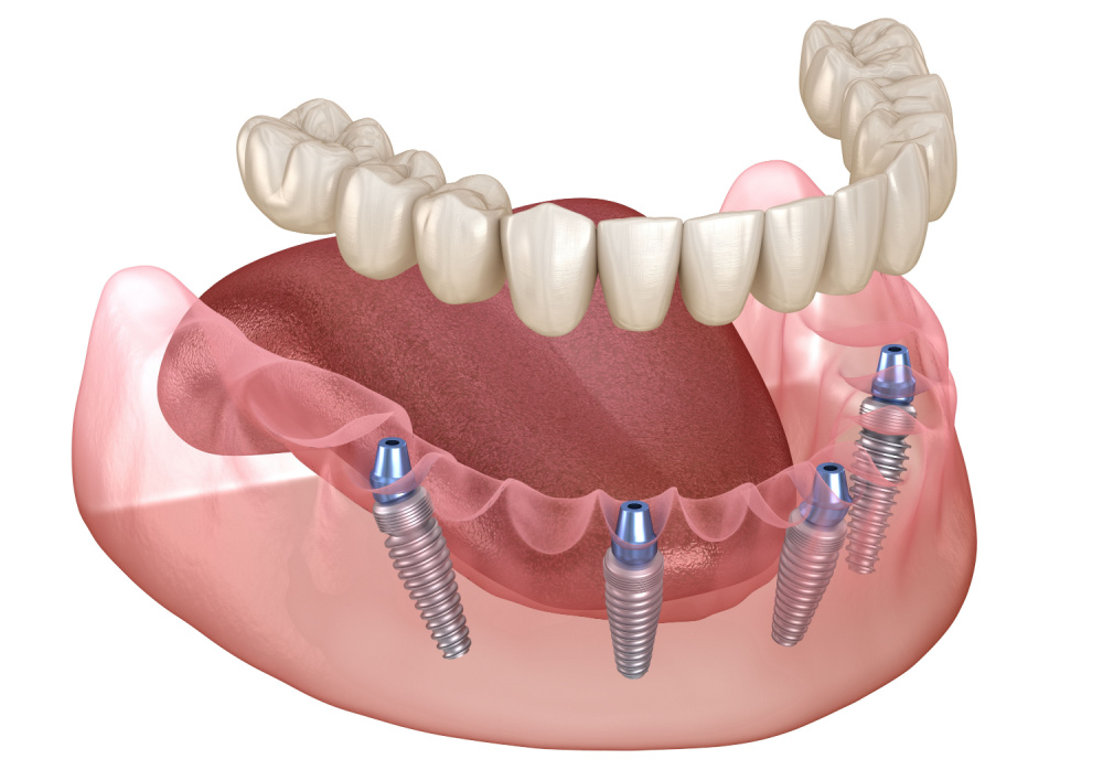 All on 4 Dental Implants North St. Louis County, MO | North St. Louis County, MO Area All-on-4 Treatment | Martin Dental
